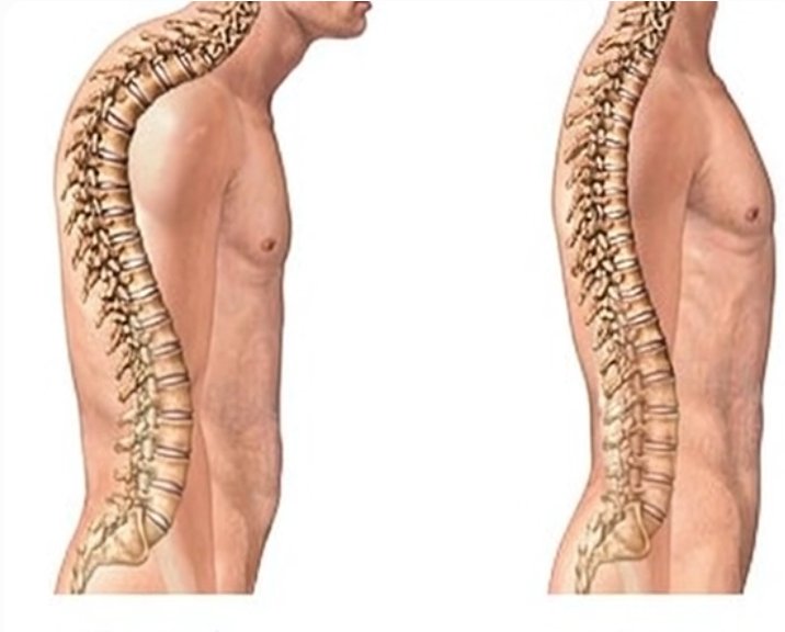 posture-spine
